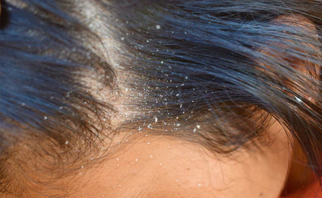 Which oil is best for dandruff and hair fall?